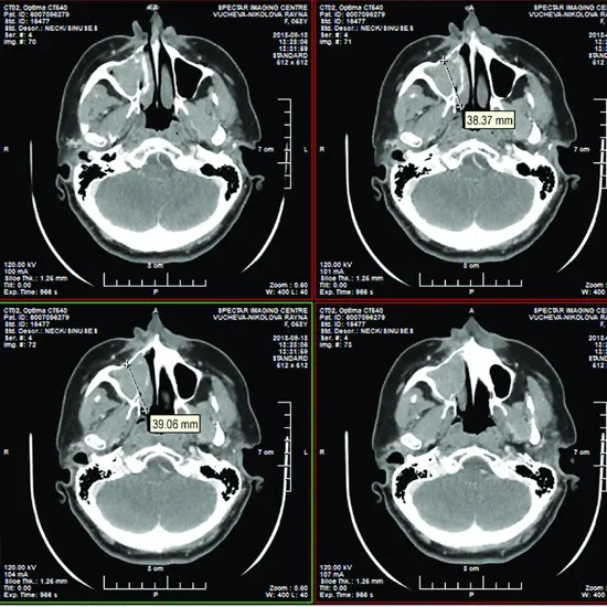 CT scan Maxilla Axial